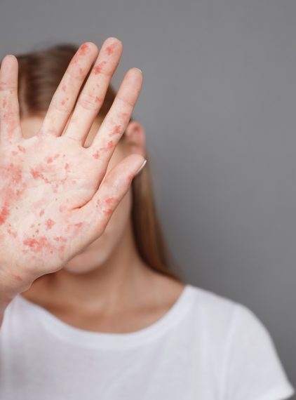 Największa epidemia odry na świecie. Ponad 167 tys. podejrzanych przypadków i ponad 1000 zgonów