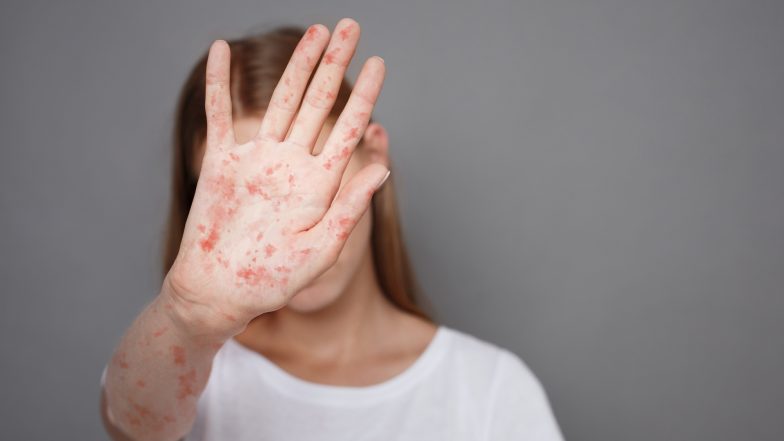 Największa epidemia odry na świecie. Ponad 167 tys. podejrzanych przypadków i ponad 1000 zgonów