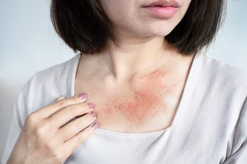 Pokrzywka stresowa. Objawy, przyczyny i diagnostyka
